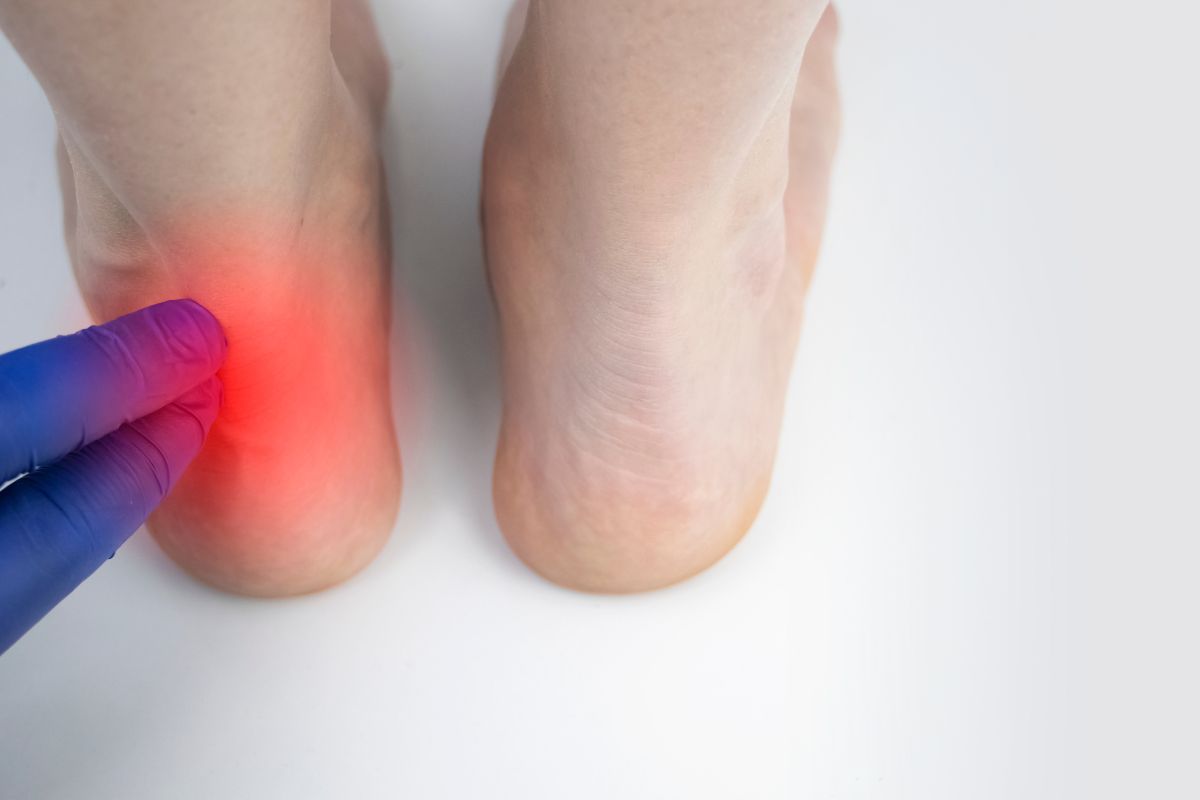 Combien de séance de kiné pour une rupture du tendon d’Achille ?